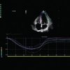 thumb: XStrain - Nichtinvasive Messung myokardialer Verformung 