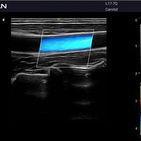 thumb: Gefäßultraschall mit dem Acclarix AX2