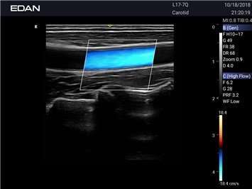 Gefäßultraschall mit dem Acclarix AX2