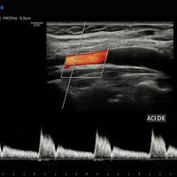 thumb: RS85 Prestige