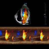 thumb: Herzscan mit dem Apogee 5800 Ace