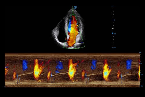 Herzscan mit dem Apogee 5800 Ace