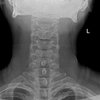 thumb: Röntgenbild der Halswirbelsäule aufgenommen mit dem Defender