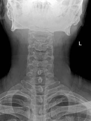 Röntgenbild der Halswirbelsäule aufgenommen mit dem Defender