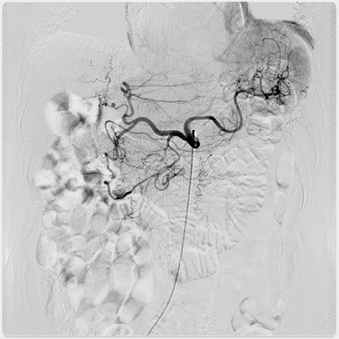 Angiographie mit dem Ultimax-i