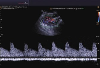 Nierenarterie PW - mit QuickScan