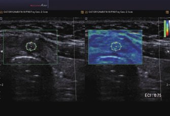 Schilddrüße - Ithmus Adenoma ElastoScan