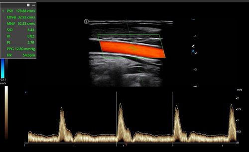 Farbdoppler mit dem Apogee 6500