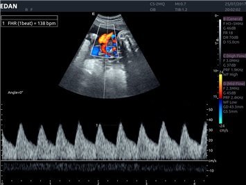 Farbdoppler mit dem Acclarix AX8