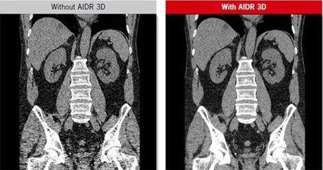 Anwendung von AIDR 3D Enhanced
