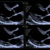 thumb: ACUSON Redwood