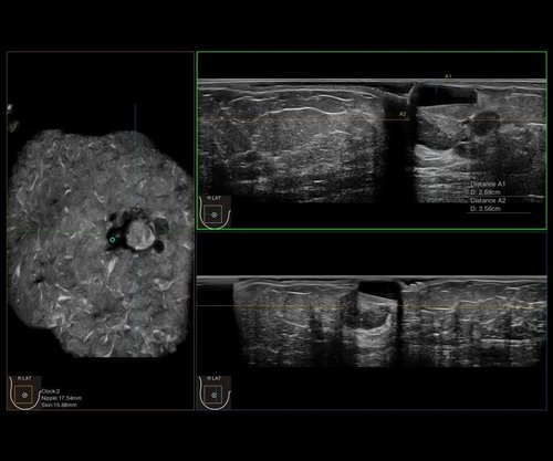 Aufnahmen der Brust mit dem IBUS 60