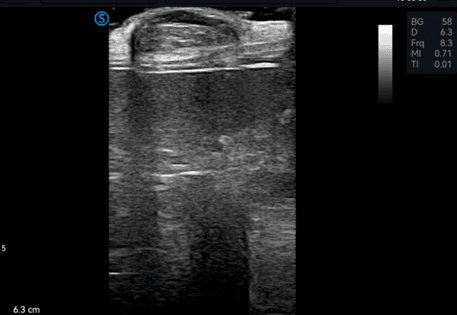 SIUI VP2 Ultraschallbild: Knoten