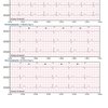 thumb: Cardiomatics Report Beispiel 3