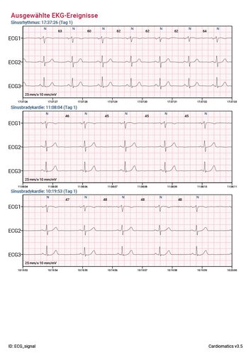 Cardiomatics Report Beispiel 3
