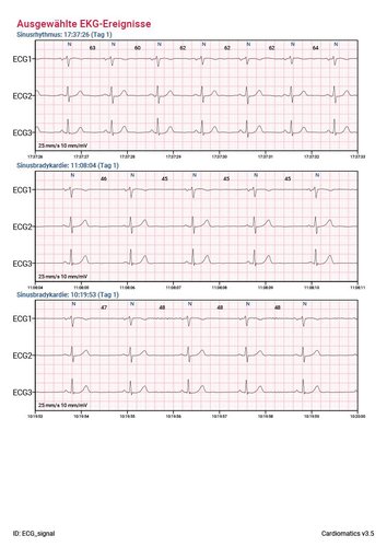 Cardiomatics Report Beispiel 3