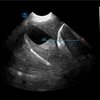 thumb: SIUI VP2 Ultraschallbild: Gallenblase