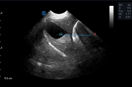SIUI VP2 Ultraschallbild: Gallenblase