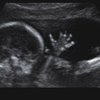 thumb: Fetus