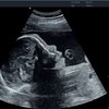 thumb: Schwangerschaftsdiagnostik mit dem Acclarix AX8