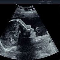 thumb: Schwangerschaftsdiagnostik mit dem Acclarix AX8