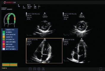 Herz-Stress-Echo - mit flexiblen und anpassbaren Protokollen für die Aufnahme und Überprüfung von Bildern