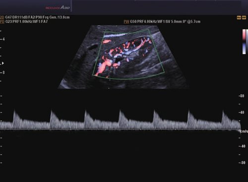 Nierengefäße PW Doppler