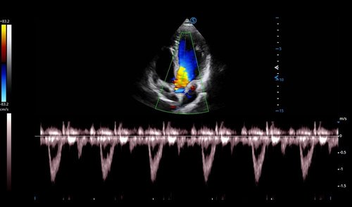 Ultraschalluntersuchung des Herzens mit dem Apogee 6500