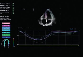 XStrain - Nichtinvasive Messung myokardialer Verformung 
