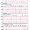 thumb: Cardiomatics Report Beispiel 7