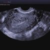 thumb: Uterus Adenomyosis