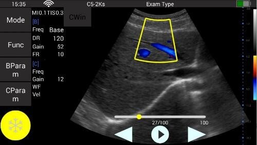 Abdominalscan mit dem Farbdoppler des Youkey QSONO D8