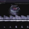 thumb: Nierenarterie PW - ohne QuickScan