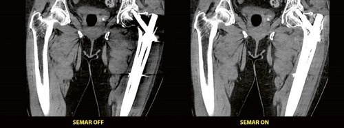 SEMAR mit dem Aquilion Lightning SP