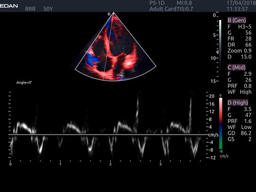 Tissue Velocity Imaging