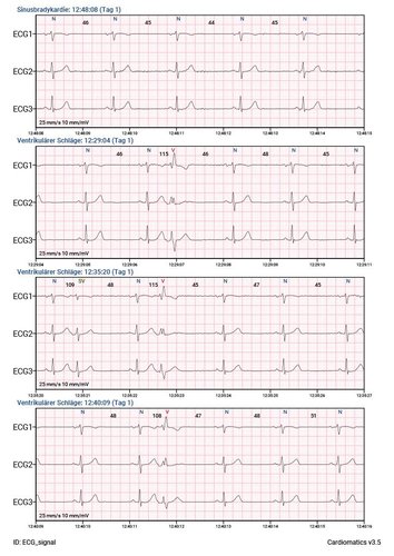 Cardiomatics Report Beispiel 4