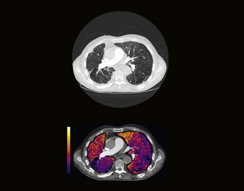 Scan mit SURESubtraction™ Lung 