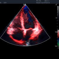 thumb: Tissue Doppler Imaging