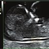 thumb: AutoNT - Automatische Messung der fetalen Nackentransparenz
