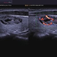 thumb: Schilddrüße-Adenoma Doppelbild-Modus