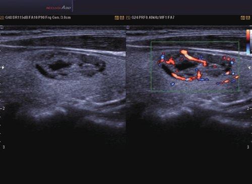 Schilddrüße-Adenoma Doppelbild-Modus