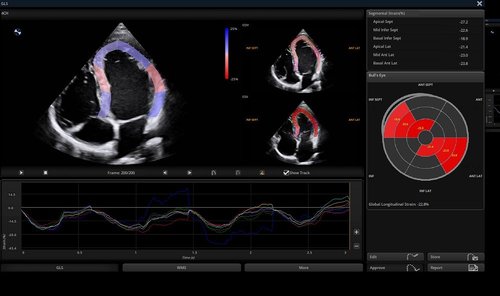 Herzscan mit dem Apogee 6500