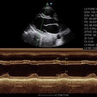 thumb: Ultraschalluntersuchung mit dem Apogee 5300