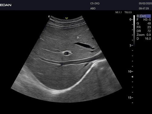 Abdominalscan mit dem Acclarix AX8 mit eSRI