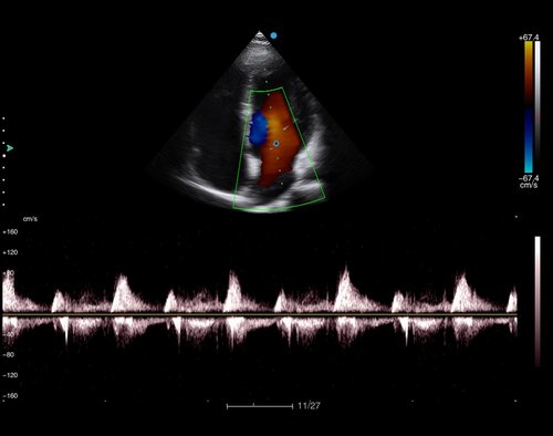 Herzscan mit dem Apogee 6200