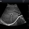 thumb: Ultraschall der Leber mit dem Acclarix AX2