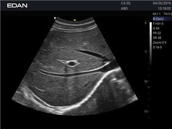 Ultraschall der Leber mit dem Acclarix AX2