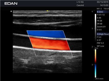 Gefäßdarstellung mit dem Acclarix LX3