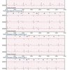 thumb: Cardiomatics Report Beispiel 5