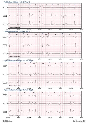 Cardiomatics Report Beispiel 5